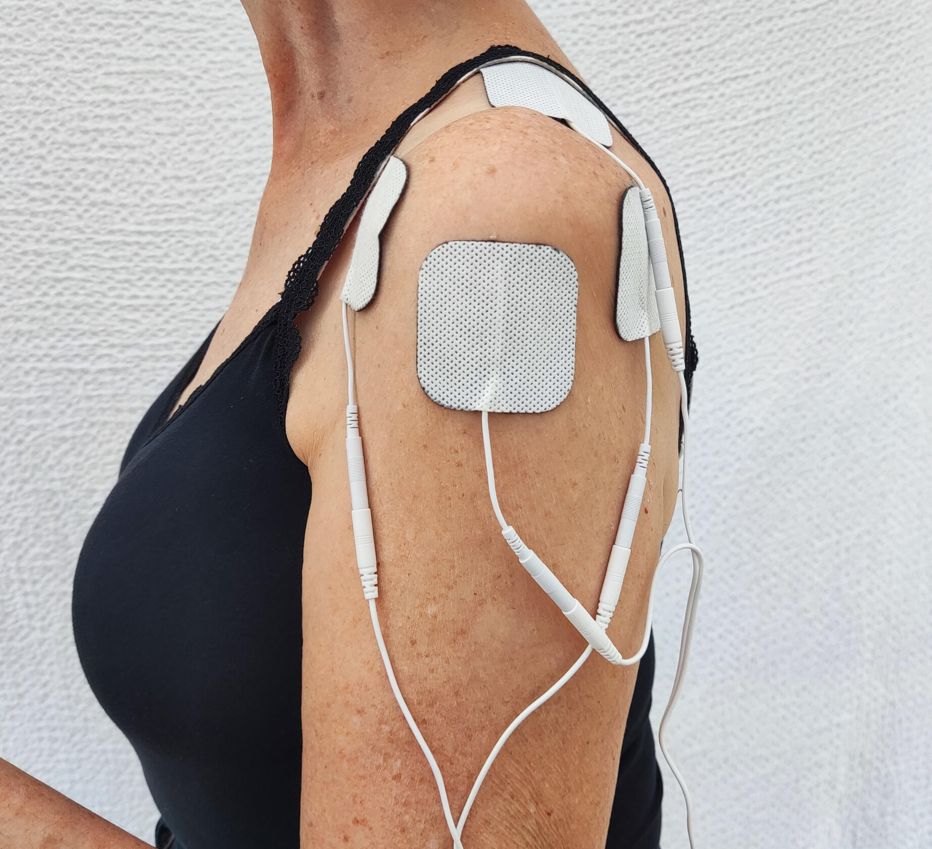 Electrical Stimulation Shoulder Transcutaneous electrical nerve stimulation (TENS) unit electrodes positioned on the shoulder with gel pads and connecting leads for therapeutic pain management